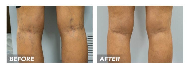 Nationally Recognized Vein Doctor  What can go wrong with sclerotherapy? We  answer your questions about spider vein treatments