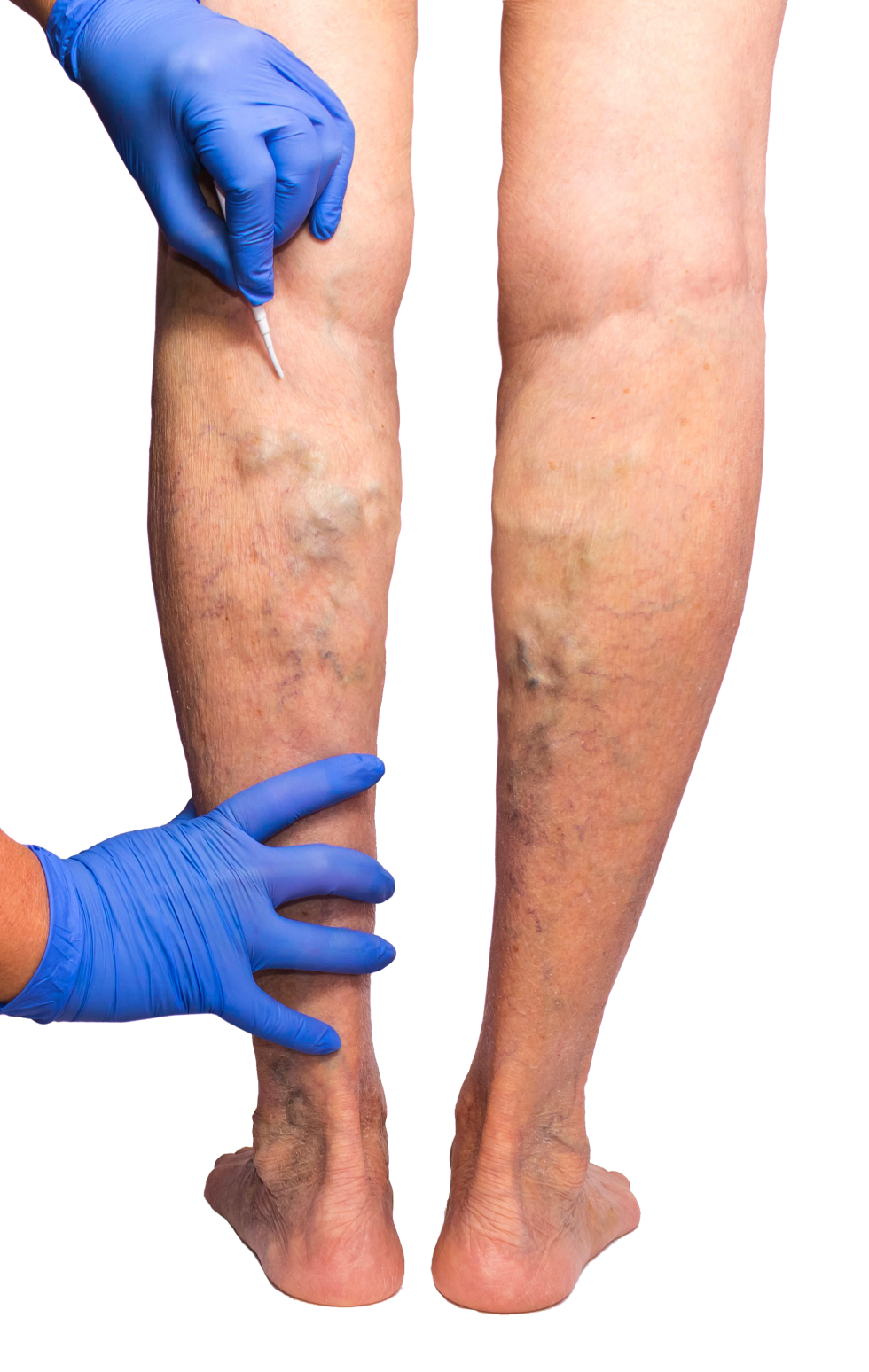 Harvard Trained Vein Doctor Vein Doctor in Newark Answers FAQs about