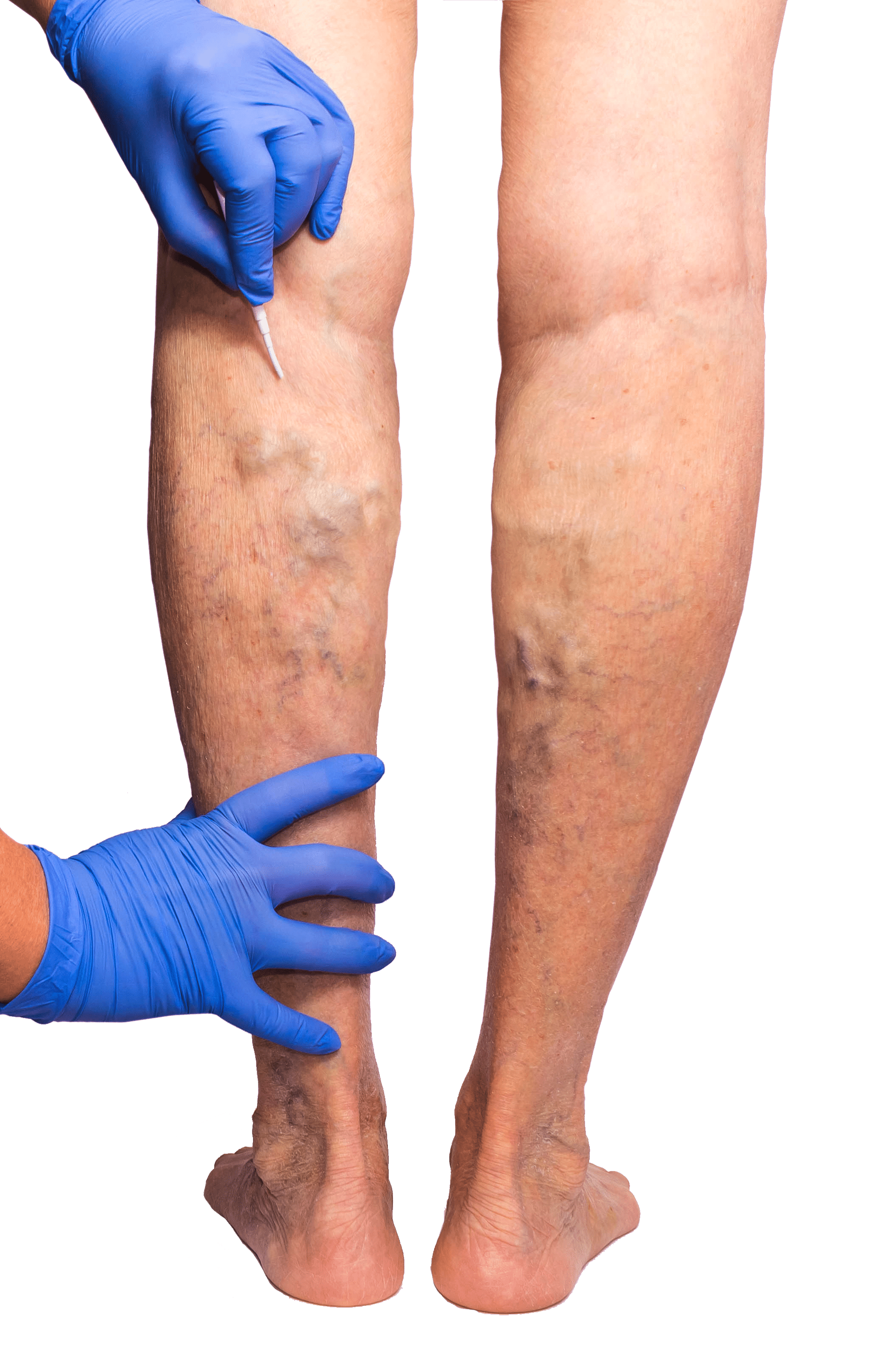 What is a Vein Center?