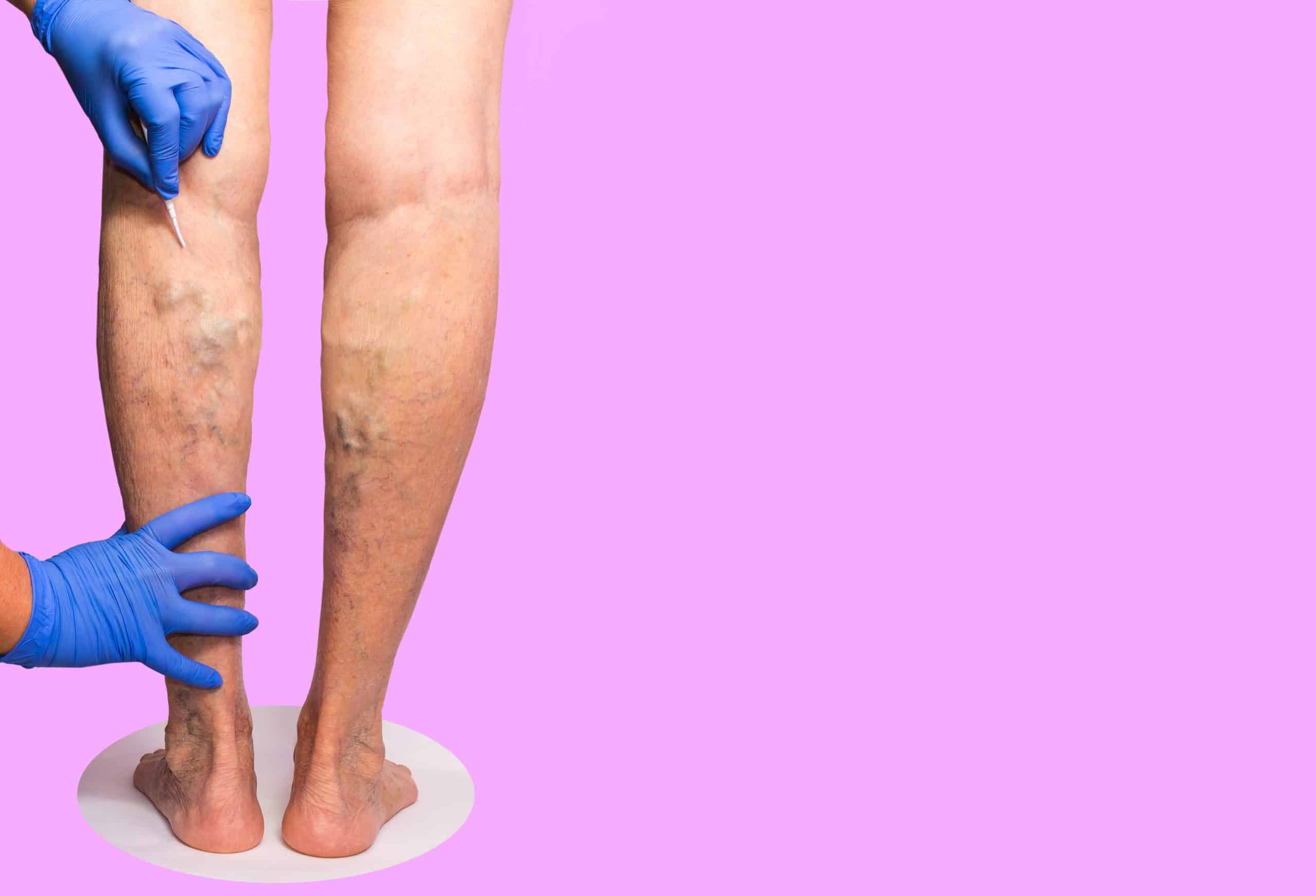 What are the treatment options for varicose veins