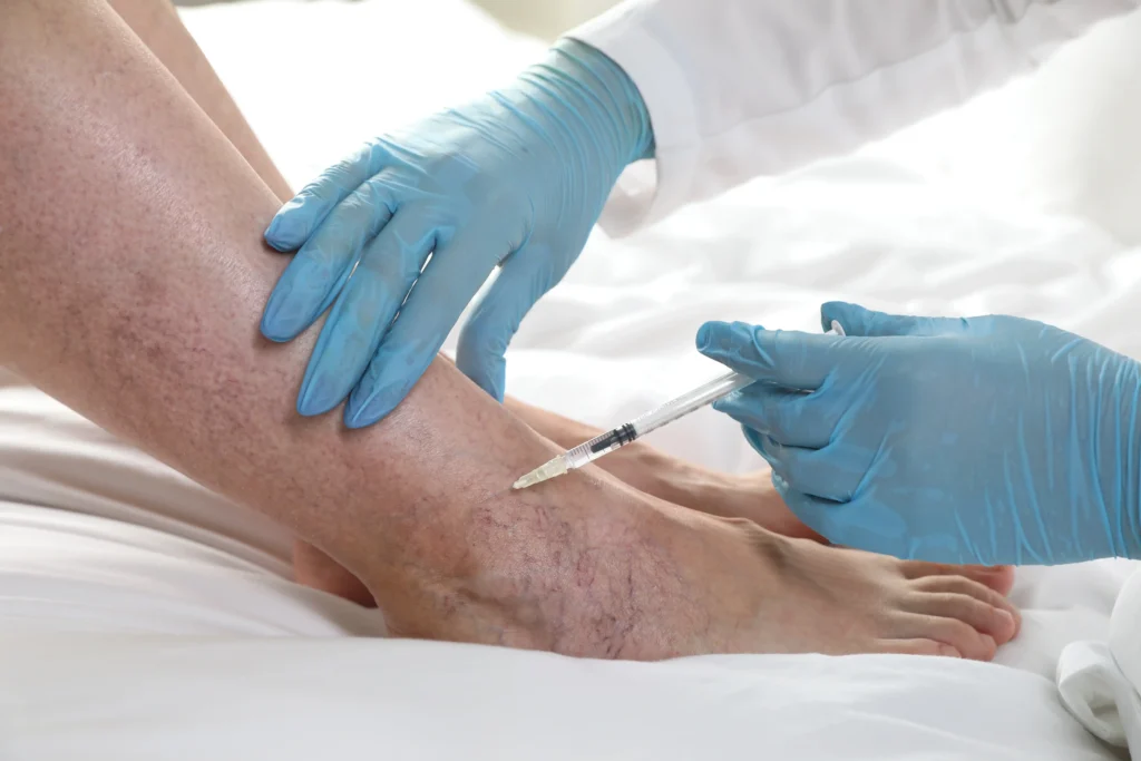 Know Your Options | 4 Ways to Treat Spider Veins in Clifton, New Jersey