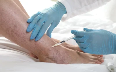 Know Your Options | 4 Ways to Treat Spider Veins in Clifton, New Jersey